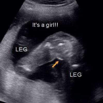 Early Gender Ultrasound