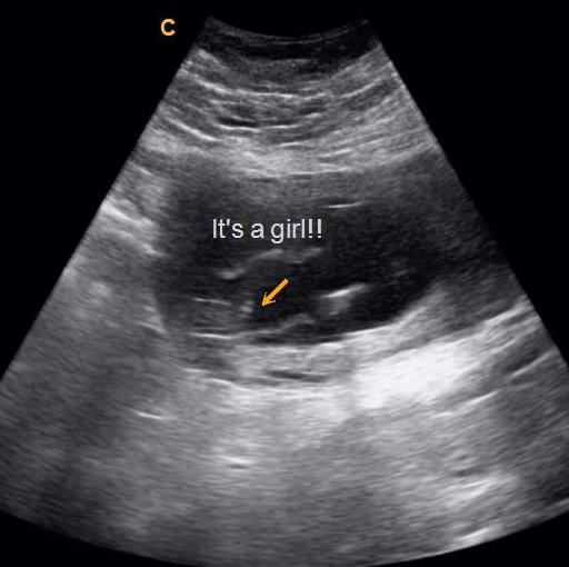 14 Week Ultrasound Gender Reveal Gender Reveal Ultrasound Hot Sex Picture