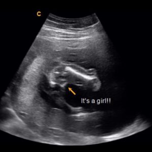 14 weeks gender ultrasound