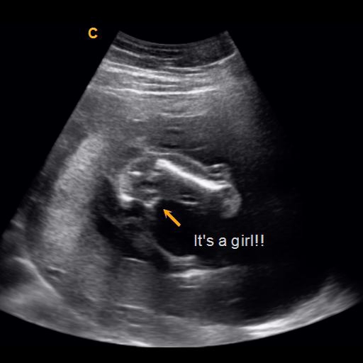 Early Gender Girls 14 Weeks 3d 4d 5d Hd Ultrasound Michigan