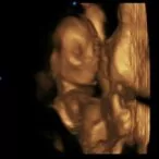 18 weeks 3d ultrasound