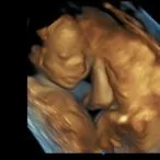 20 weeks 3d ultrasound