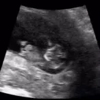 9 weeks 3d ultrasound