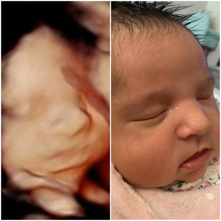 3d ultrasound before and after 5d ultrasound and after birth