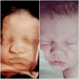 3D ultrasound 5D ultrasound photo compared to birth photo