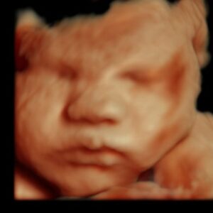 4d 5d ultrasound