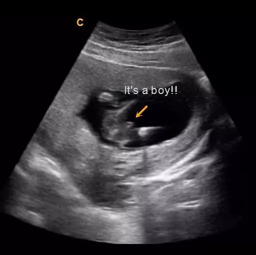 14 Weeks Gender Ultrasound Boy | 3D Baby Michigan
