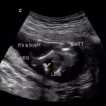 14 weeks gender ultrasound boy