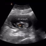 14 weeks gender ultrasound boy