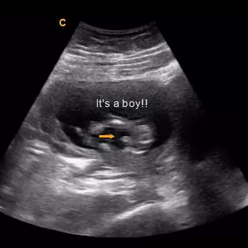14 Weeks Gender Ultrasound Boy | 3D Baby Michigan