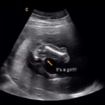 14 weeks gender ultrasound girl