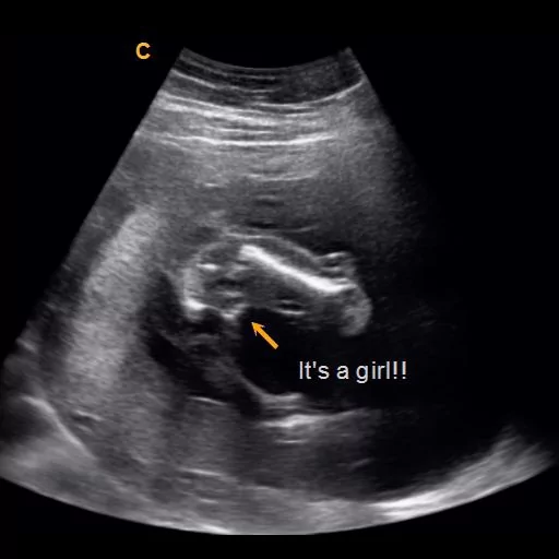 Baby Gender Reveal Baby Photo Album Sonogram Ultrasound Boy Girl