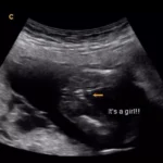 14 weeks gender ultrasound girl