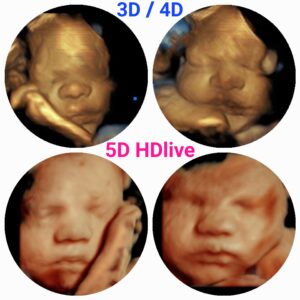 3d ultrasound vs 5d ultrasound