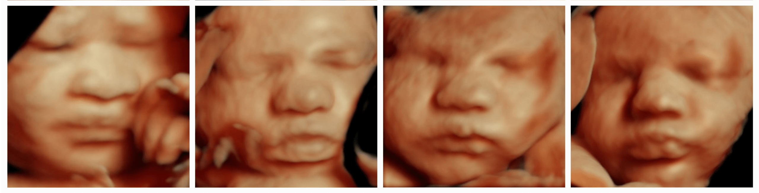 3D 4D 5D HD Ultrasound Packages | Early Gender