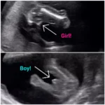 Early-gender-ultrasound
