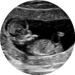 2D ultrasound