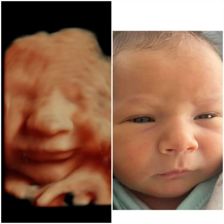 3D 4D ultrasound vs baby