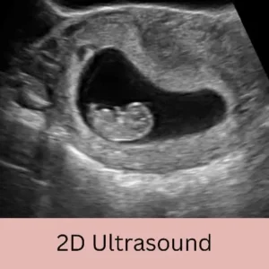 Early pregnancy ultrasound of baby at 8 weeks, with text that reads "2D Ultrasound"