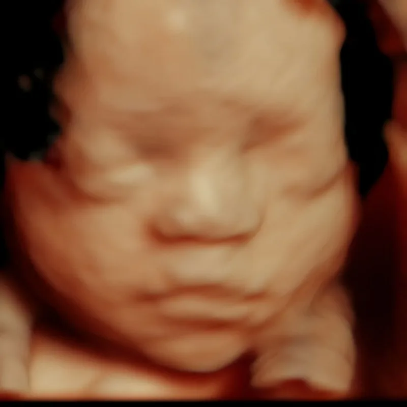 3D ultrasound imaging