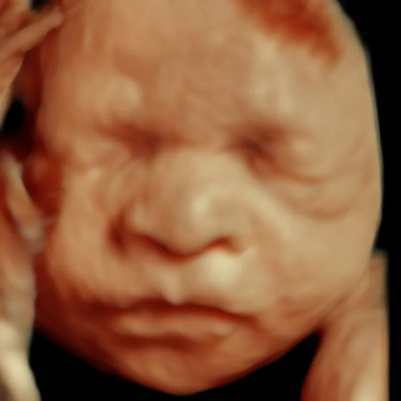 3D ultrasounds