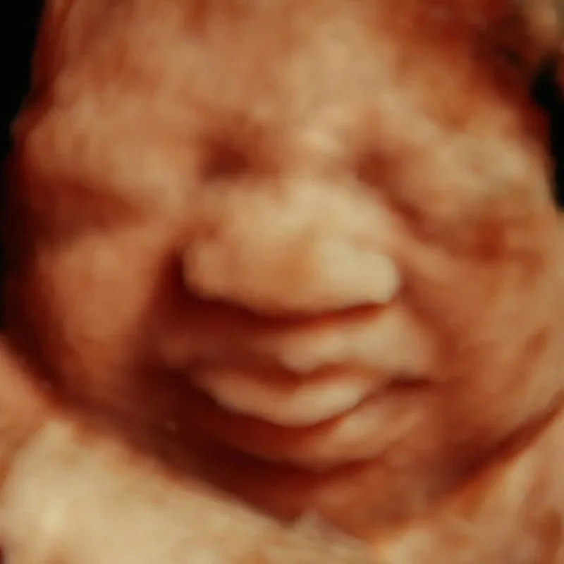 3D/4D ultrasounds