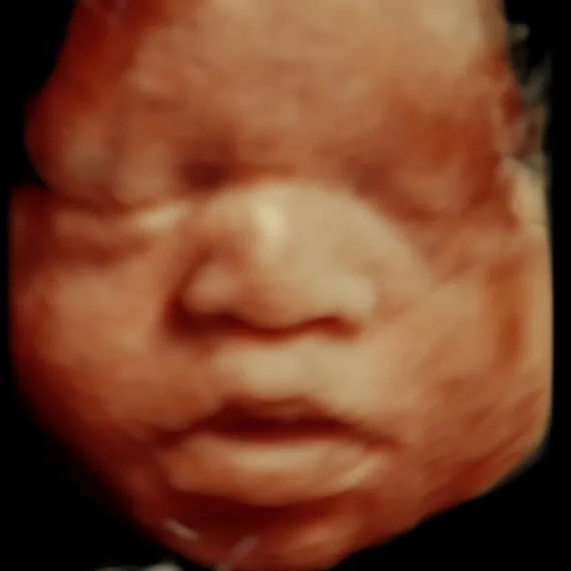 prenatal ultrasound