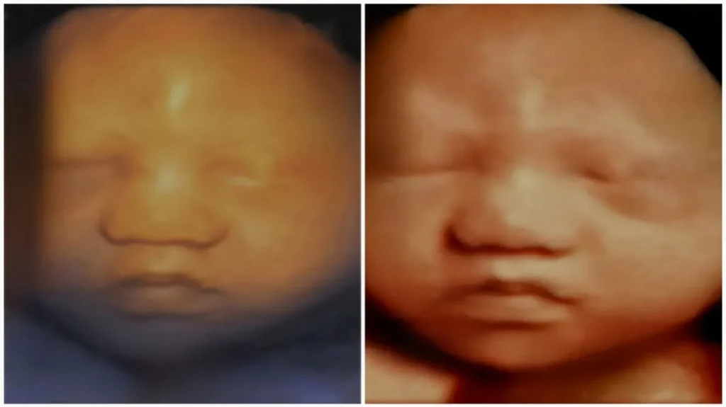 5d sonogram compared to a 3d sonogram