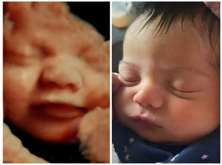 3D ultrasound picture comparison