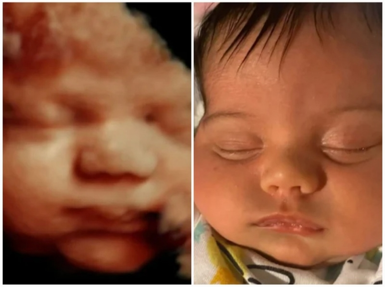 3D ultrasound compared to baby